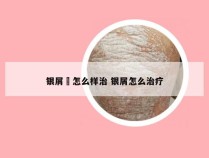 银屑廯怎么样治 银屑怎么治疗