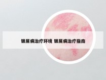 银屑病治疗环境 银屑病治疗指南