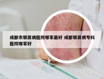 成都市银屑病医院哪家最好 成都银屑病专科医院哪家好