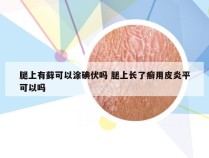 腿上有藓可以涂碘伏吗 腿上长了癣用皮炎平可以吗