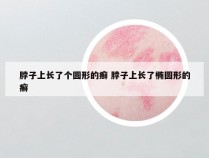 脖子上长了个圆形的癣 脖子上长了椭圆形的癣