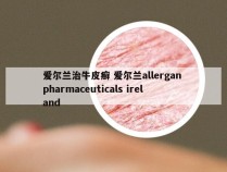 爱尔兰治牛皮癣 爱尔兰allergan pharmaceuticals ireland