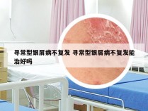 寻常型银屑病不复发 寻常型银屑病不复发能治好吗