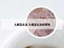 人癣怎么治 人癣怎么治好得快