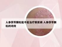 人参茯苓颗粒能不能治疗银屑病 人参茯苓颗粒的功效