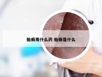 胎癣用什么药 胎癣是什么