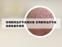 生物制剂治疗牛皮癫价格 生物制剂治疗牛皮皮癣有副作用吗