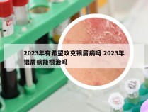 2023年有希望攻克银屑病吗 2023年银屑病能根治吗