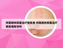 阿莫西林胶囊治疗银屑病 阿莫西林胶囊治疗银屑病有效吗