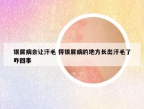 银屑病会让汗毛 得银屑病的地方长出汗毛了咋回事