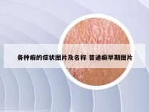 各种癣的症状图片及名称 普通癣早期图片