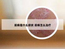 尿癣是什么症状 尿癣怎么治疗