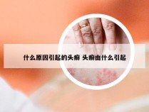 什么原因引起的头癣 头癣由什么引起