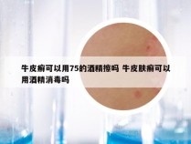 牛皮癣可以用75的酒精擦吗 牛皮肤癣可以用酒精消毒吗