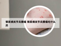 银屑病关节炎腰痛 银屑病关节炎腰痛吃什么药