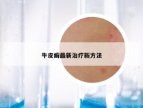 牛皮癣最新治疗新方法