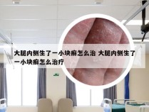 大腿内侧生了一小块癣怎么治 大腿内侧生了一小块癣怎么治疗