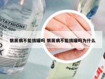 银屑病不能拔罐吗 银屑病不能拔罐吗为什么