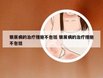 银屑病的治疗措施不包括 银屑病的治疗措施不包括