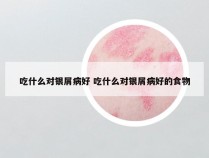 吃什么对银屑病好 吃什么对银屑病好的食物