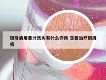 银屑病用姜汁洗头有什么作用 生姜治疗银屑病