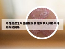 不死癌症之牛皮癣银屑病 银屑病人终身不得癌症的因果