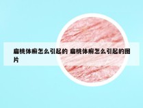 扁桃体癣怎么引起的 扁桃体癣怎么引起的图片