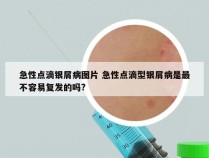 急性点滴银屑病图片 急性点滴型银屑病是最不容易复发的吗?