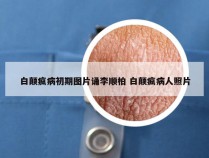 白颠疯病初期图片诵李顺柏 白颠疯病人照片