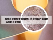 咳嗽感冒会加重银屑病吗 感冒引起的银屑病 治愈后会复发吗