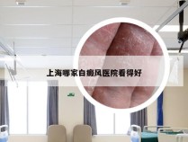 上海哪家白癜风医院看得好