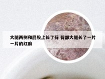 大腿两侧和屁股上长了藓 臀部大腿长了一片一片的红癣