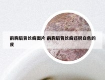 前胸后背长癣图片 前胸后背长癣还脱白色的皮