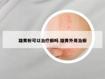 雄黄粉可以治疗癣吗 雄黄外用治癣