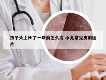 孩子头上长了一块癣怎么治 小儿常见皮癣图片