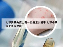 七岁男孩头皮上有一团癣怎么回事 七岁小孩头上长头皮屑