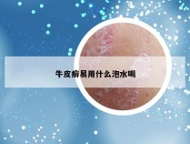 牛皮癣易用什么泡水喝