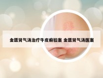 金匮肾气汤治疗牛皮癣验案 金匮肾气汤医案