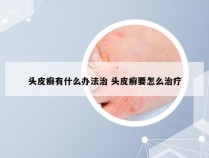 头皮癣有什么办法治 头皮癣要怎么治疗