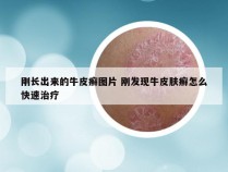 刚长出来的牛皮癣图片 刚发现牛皮肤癣怎么快速治疗