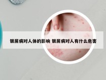 银屑病对人体的影响 银屑病对人有什么危害