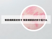 银屑病鳞屑的样子 银屑病鳞屑的样子是什么