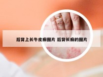 后背上长牛皮癣图片 后背长癣的图片