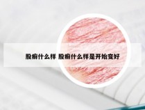 股癣什么样 股癣什么样是开始变好