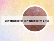 治疗银癣病的土方 治疗银癣病的土方是什么