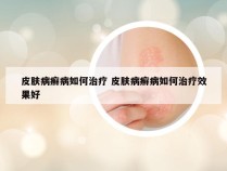 皮肤病癣病如何治疗 皮肤病癣病如何治疗效果好