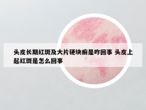 头皮长期红斑及大片硬块癣是咋回事 头皮上起红斑是怎么回事