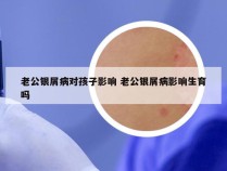 老公银屑病对孩子影响 老公银屑病影响生育吗