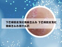 下巴痒脱皮发红像癣怎么办 下巴痒脱皮发红像癣怎么办用什么药