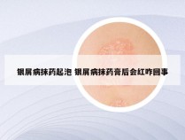 银屑病抹药起泡 银屑病抹药膏后会红咋回事